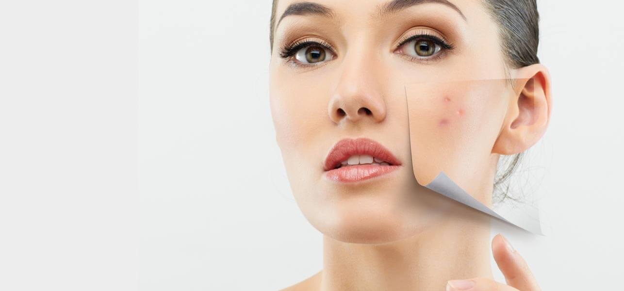 How To Get Rid Of Acne With The Help Of These 12 Ways