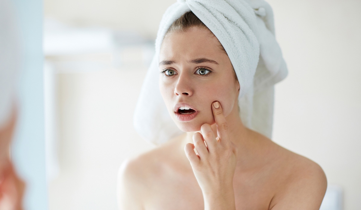 7 Ways to Get Rid of Breakouts Right In Time For Your Wedding!