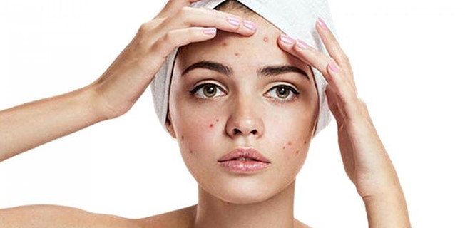 Unusual Yet Effective Remedies For Summer Breakouts